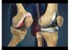 Top Joint Replacement Surgeon in Indore – Dr. Sanjay Rawat